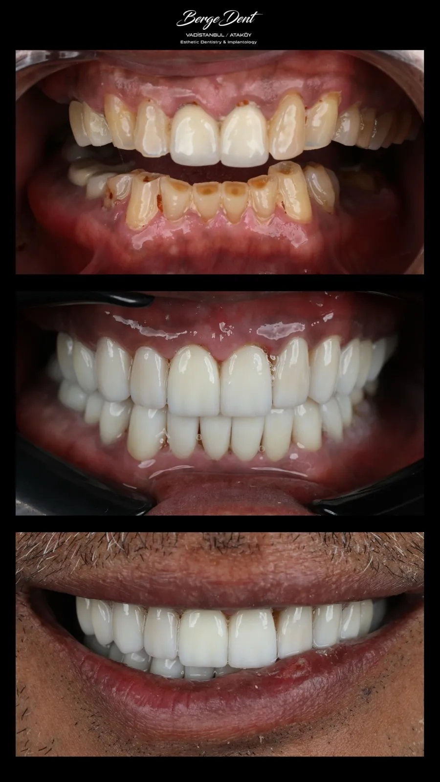Full mouth dental restoration before and after, close-up of damaged discolored teeth transformed into a bright white smile, three-stage clinical result, Turkey dental clinic.