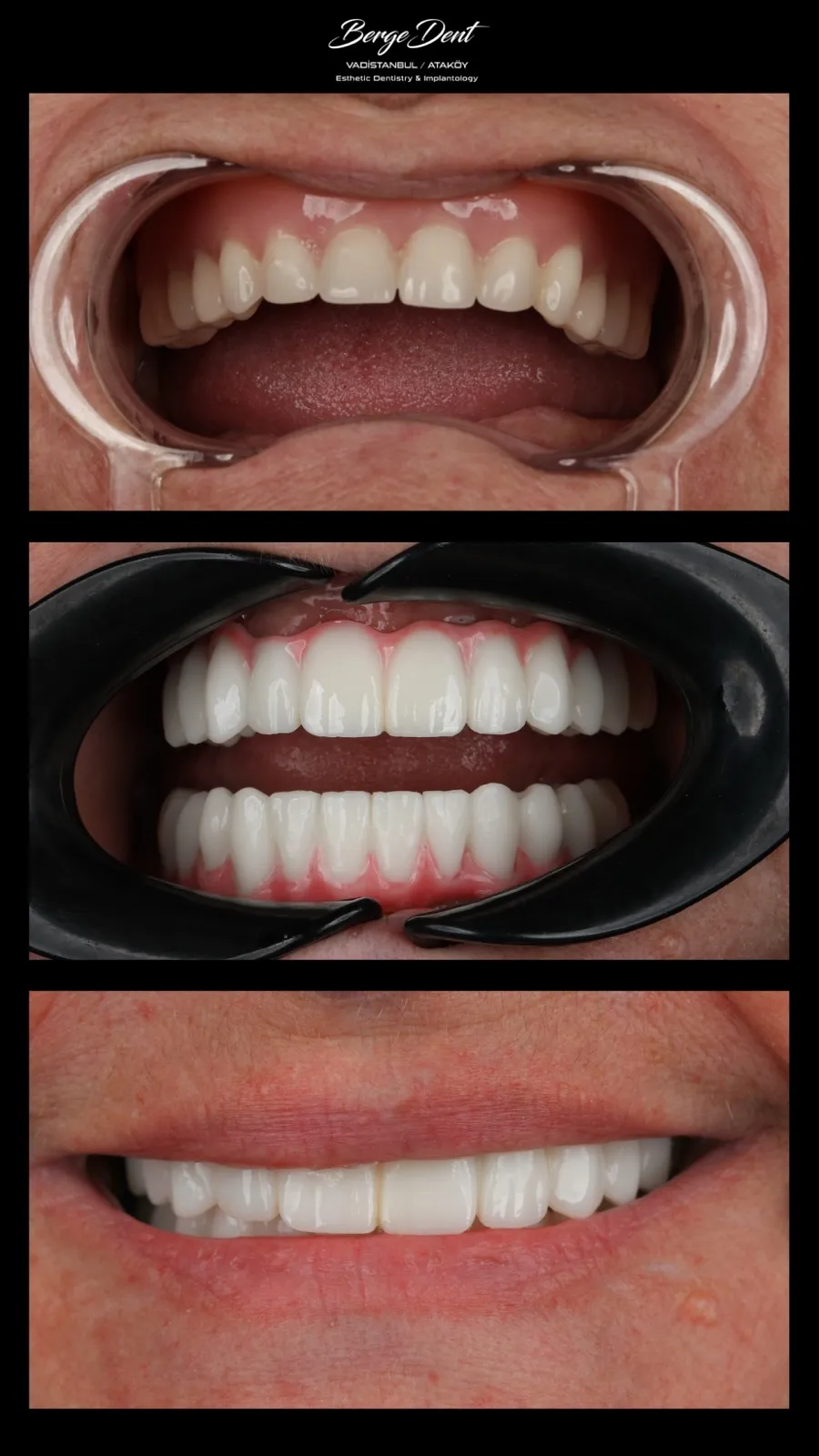 Full arch dental restoration before and after, intraoral try-in and final white ceramic result, close-up smile, Turkey dental clinic.