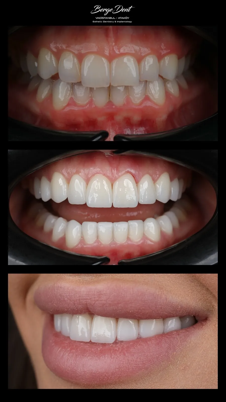 Full mouth dental restoration before and after, close-up of discolored worn teeth transformed to a white smile, Turkey dental clinic.