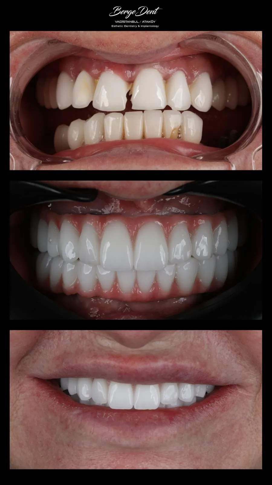 Full mouth dental restoration before and after, close-up of broken and missing front teeth transformed into a complete white smile, Turkey dental clinic.