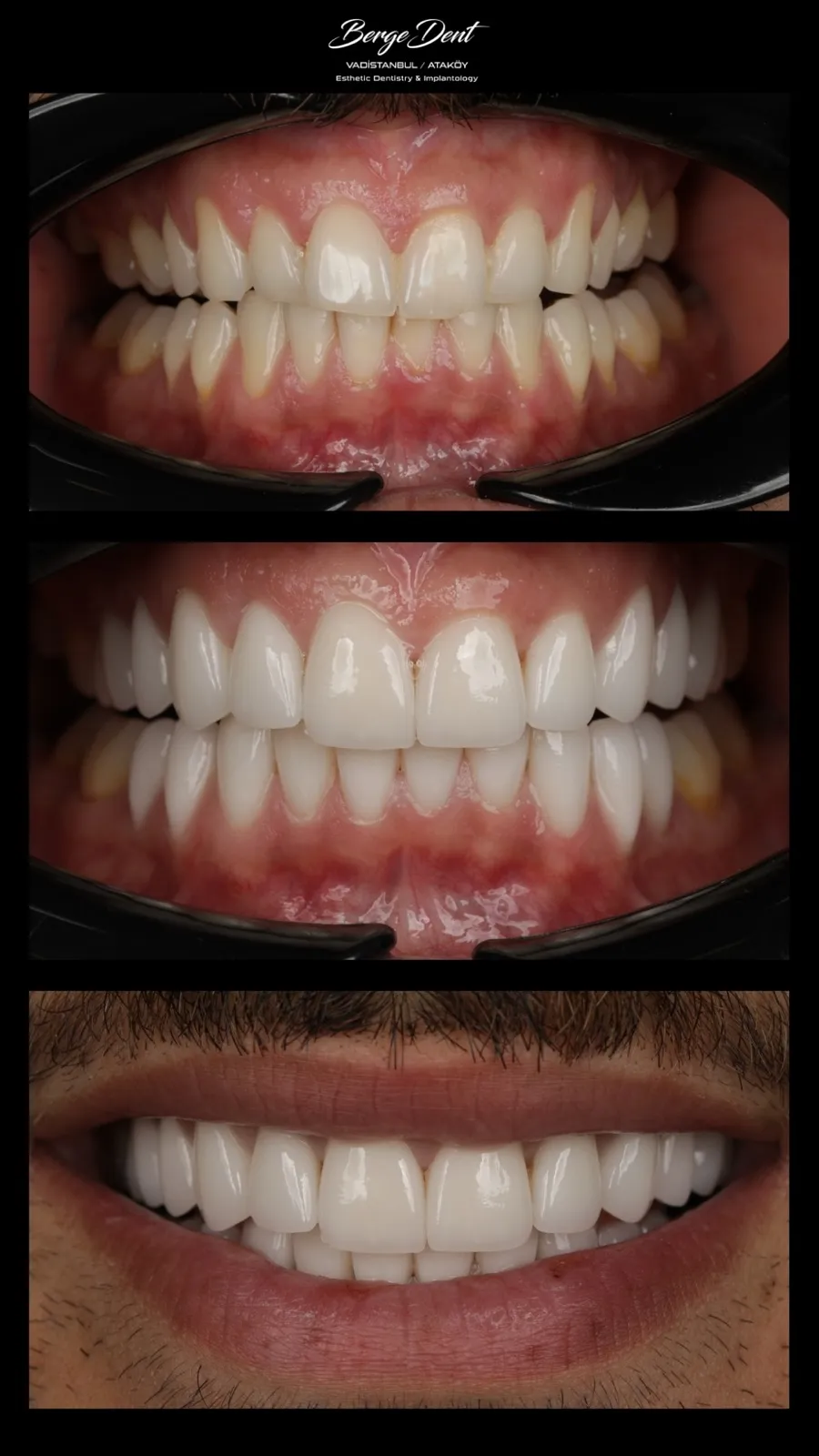 Full mouth dental restoration before and after, close-up of worn yellowed teeth transformed into a bright white smile, Turkey dental clinic.