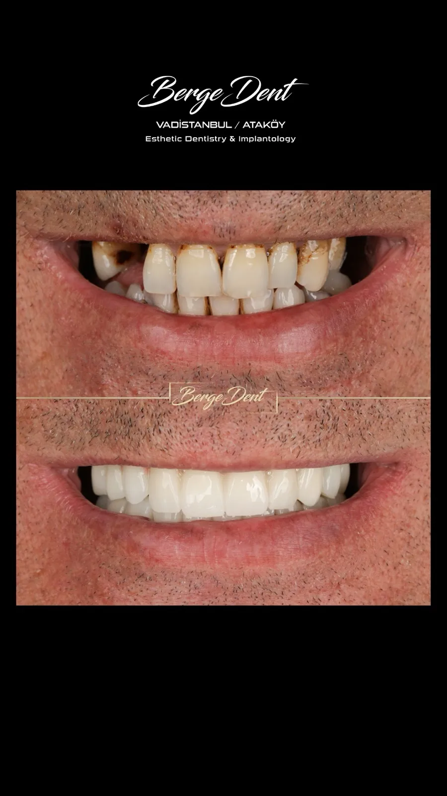Full mouth dental restoration before and after, close-up of severely decayed and missing teeth transformed into a complete white smile, Turkey dental clinic.