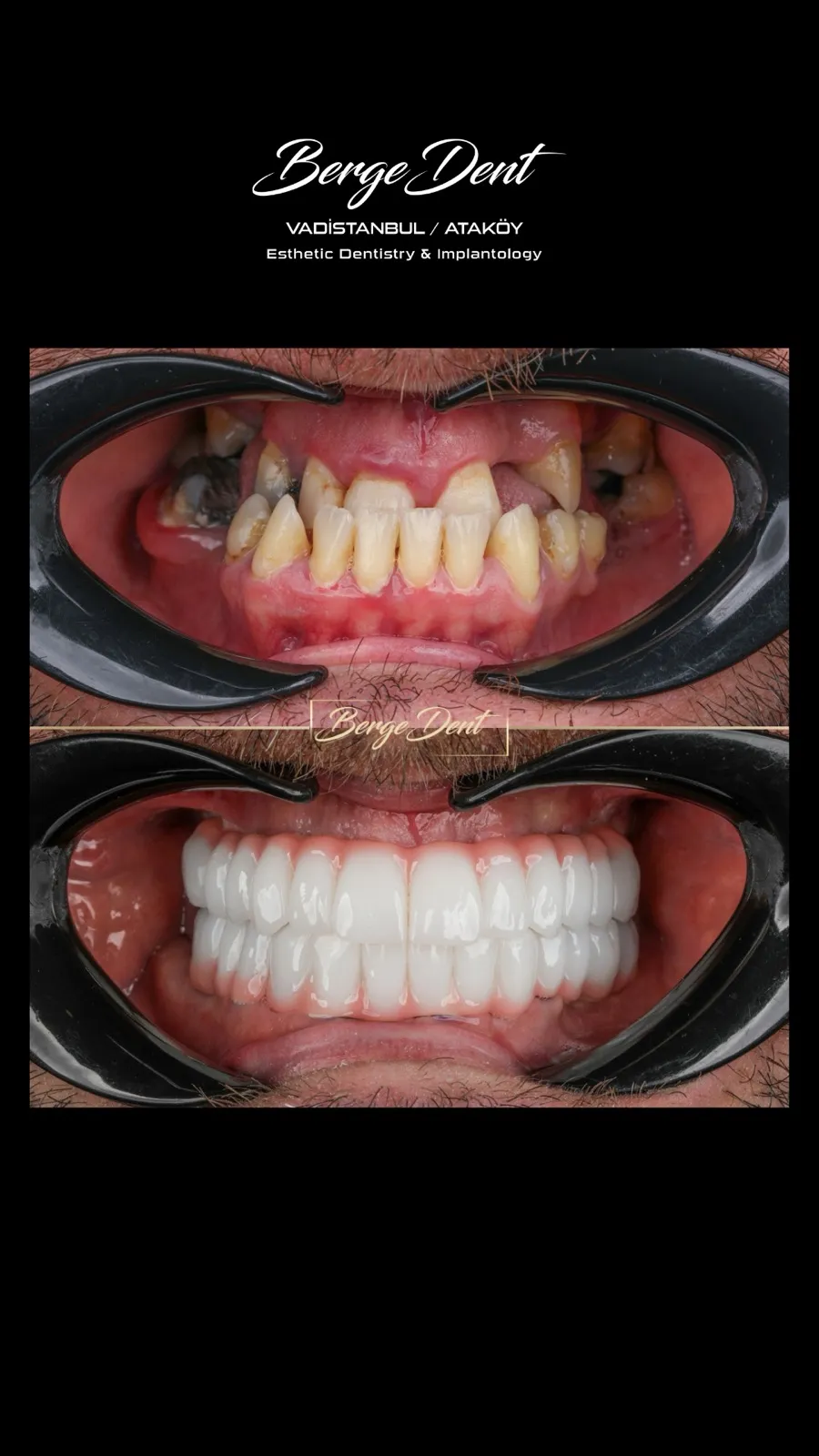 Dental restoration before and after, close-up of a chipped and discolored front tooth transformed into a bright white smile, Turkey dental clinic.