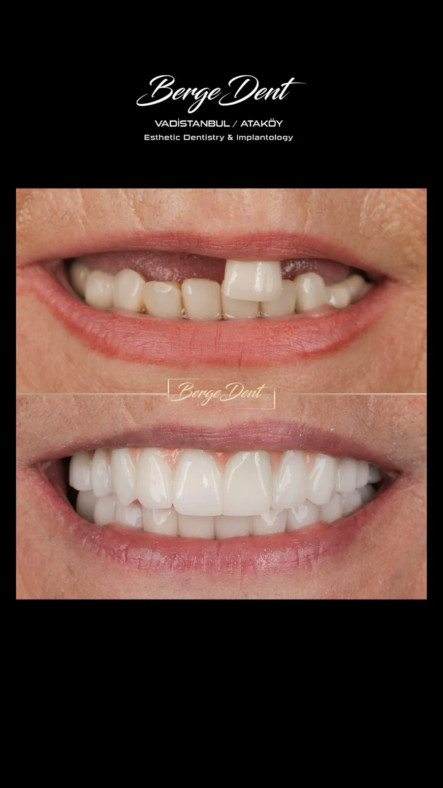 Full mouth dental restoration before and after, intraoral close-up with cheek retractors, worn teeth transformed into white ceramic restoration, Turkey dental clinic.
