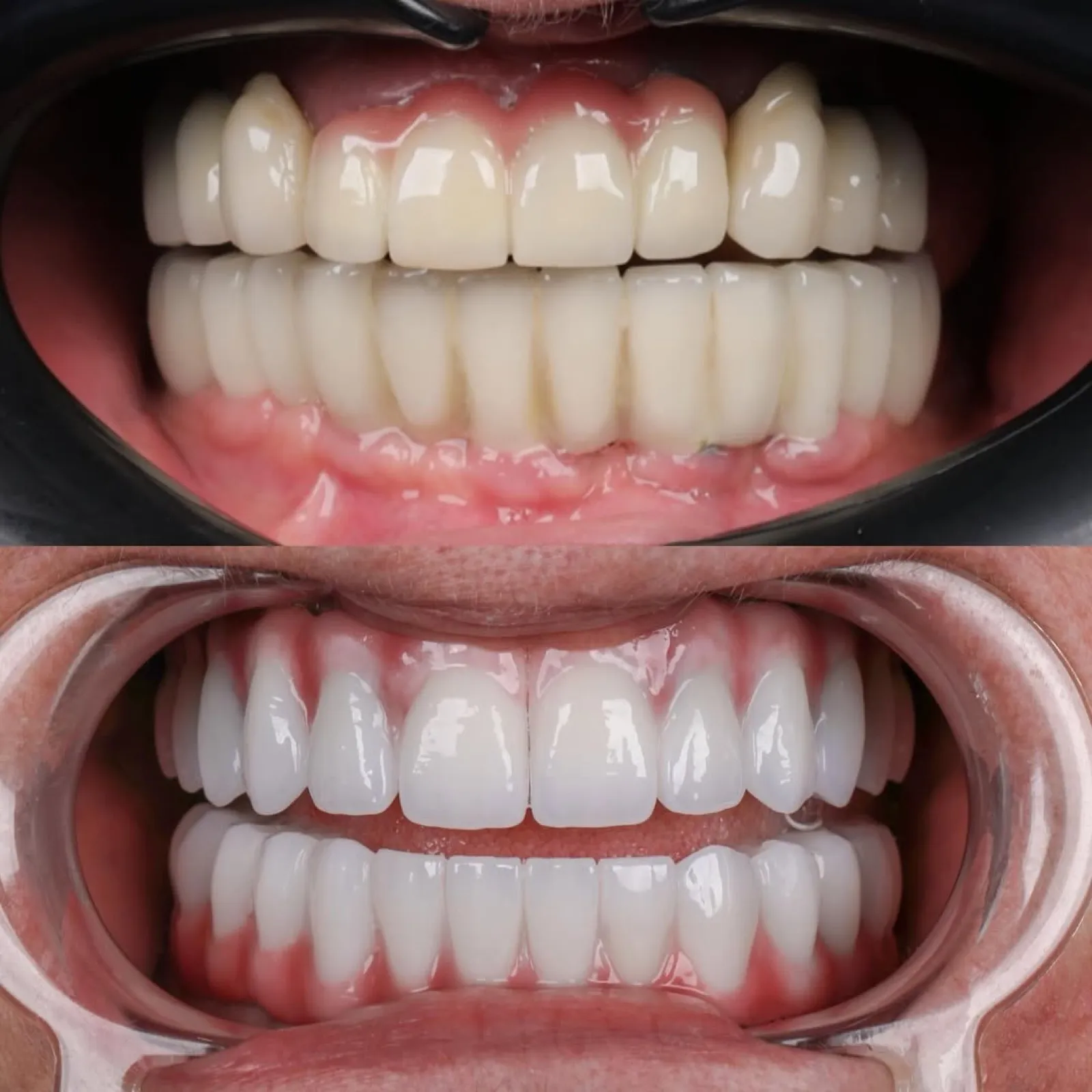 Dental patient before photo, full face, showing gapped and discolored front teeth prior to full mouth restoration, Turkey dental clinic.