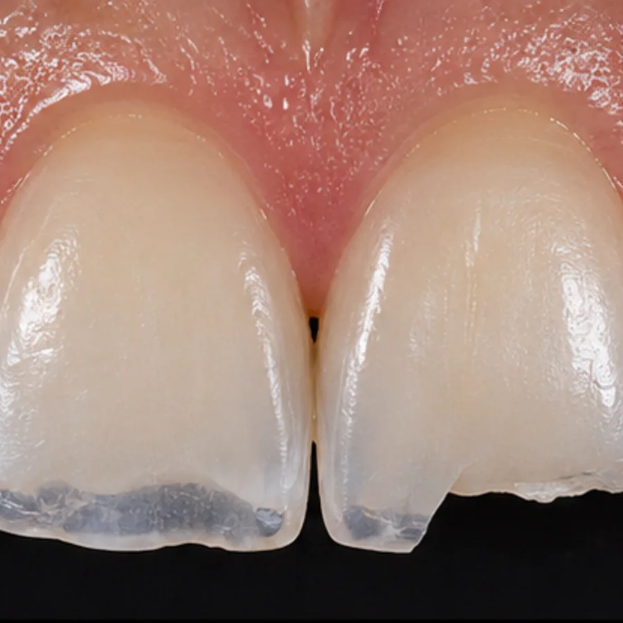 Before: composite bonding transformation, 4001