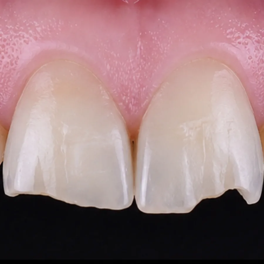 Before: composite bonding transformation, 4002