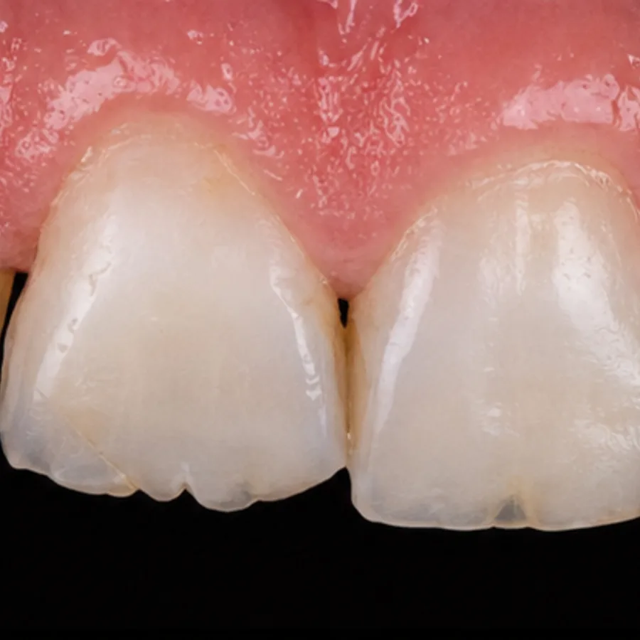 Before: composite bonding transformation, 4003
