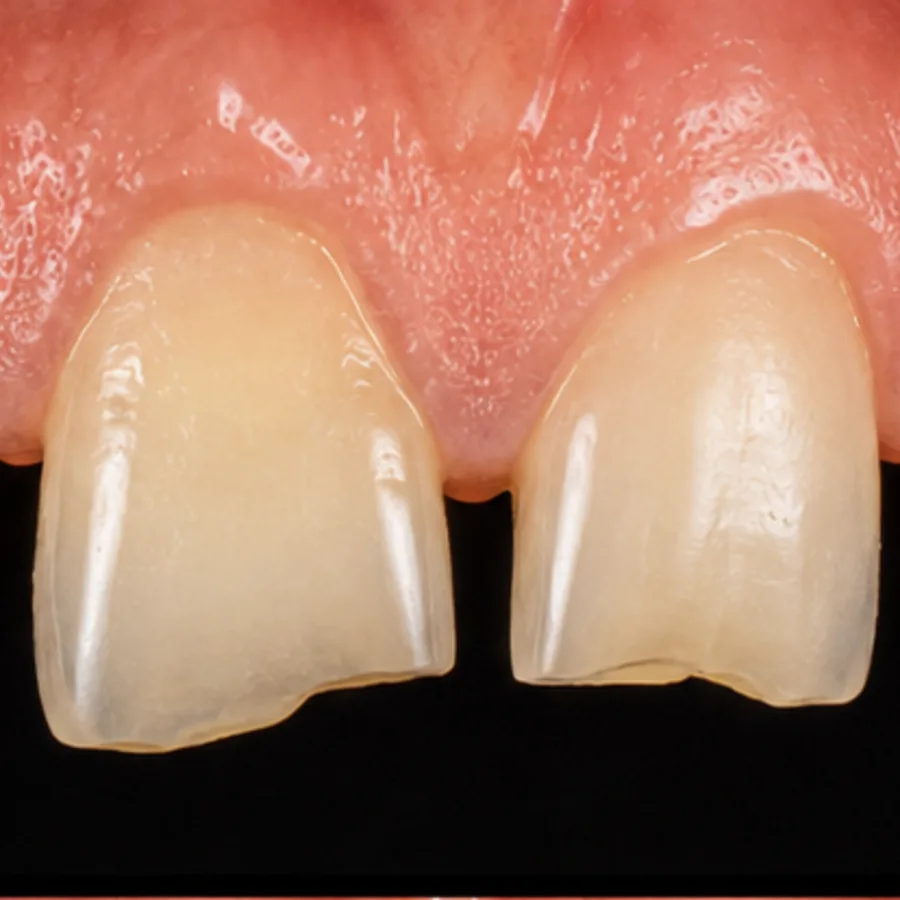 Before: composite bonding transformation, 4004