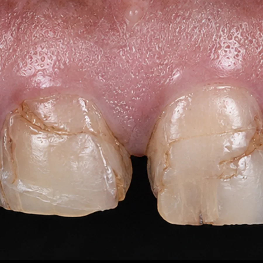 Before: composite bonding transformation, 4005