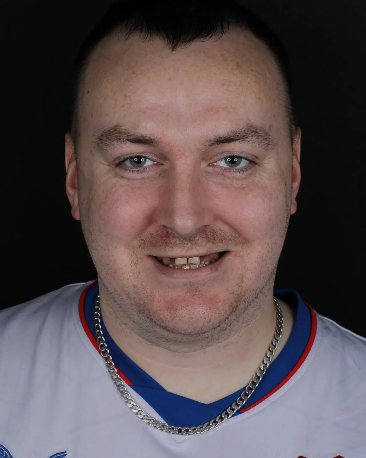 Before zirconium crown treatment, full face portrait of male patient with broken front teeth, Turkey dental clinic.