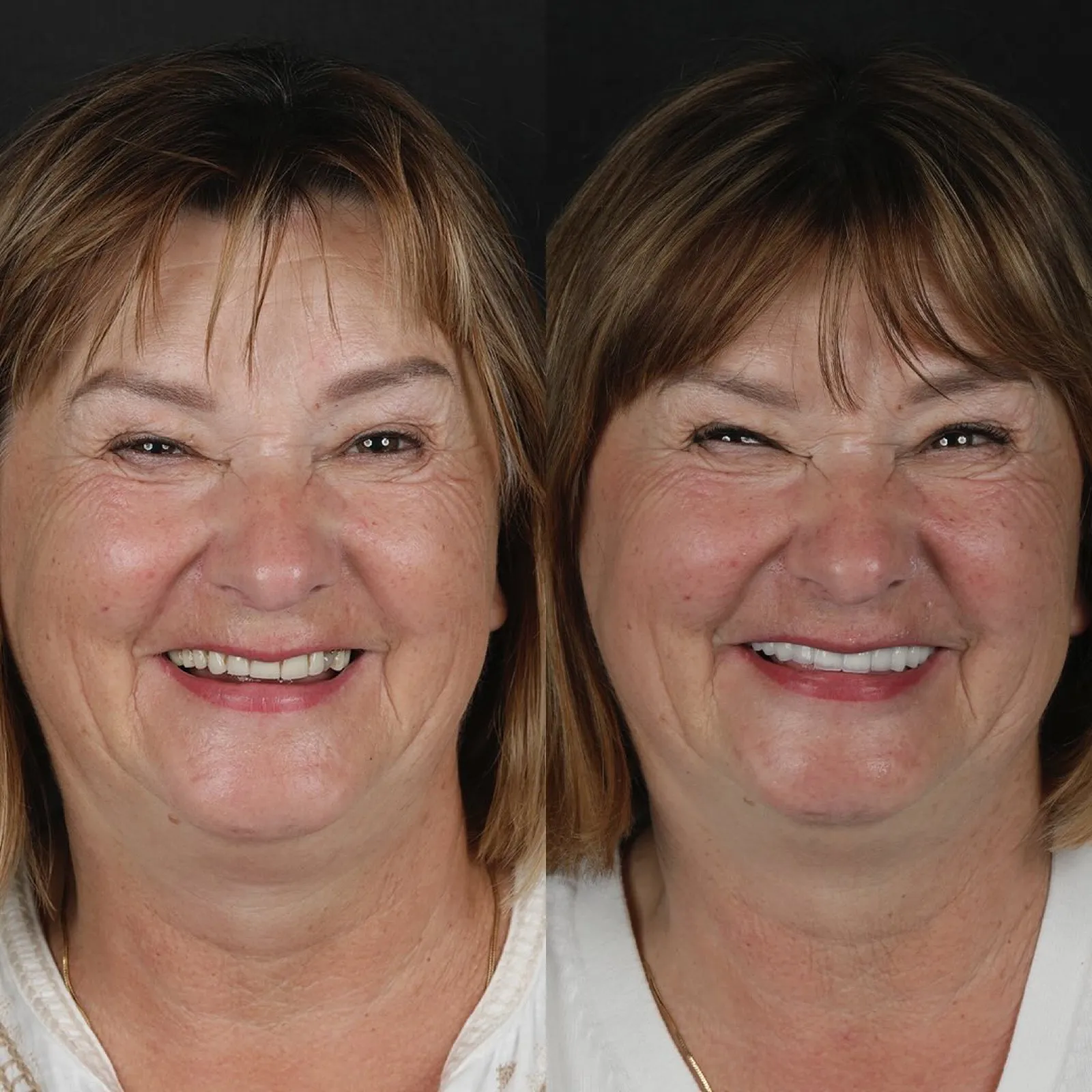 Full mouth dental implant before and after result showing complete smile transformation with All-on-Six implant supported restoration, Turkey dental clinic case.