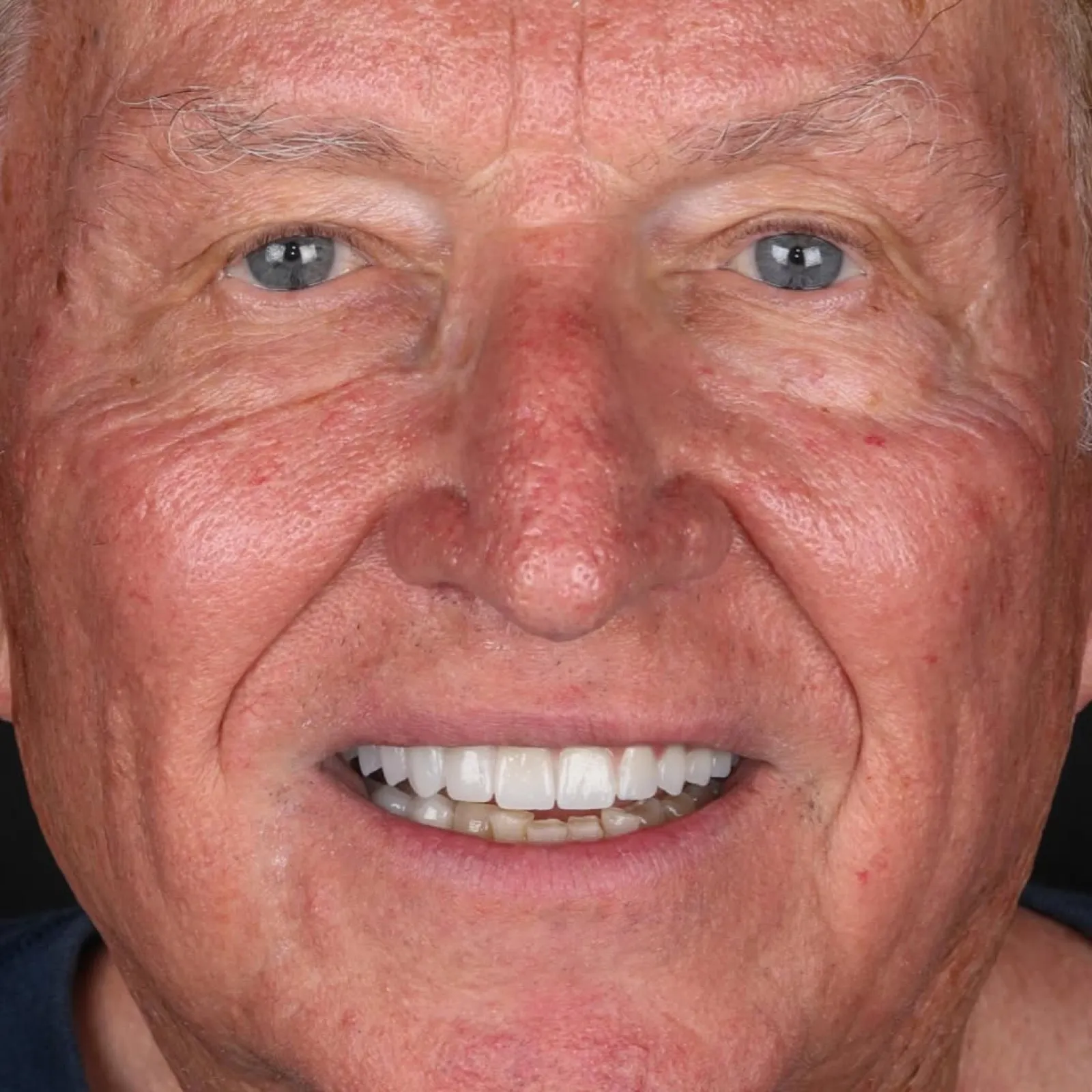 Close-up dental implant result showing new upper zirconia crowns during full mouth implant restoration, Turkey dental clinic photo.