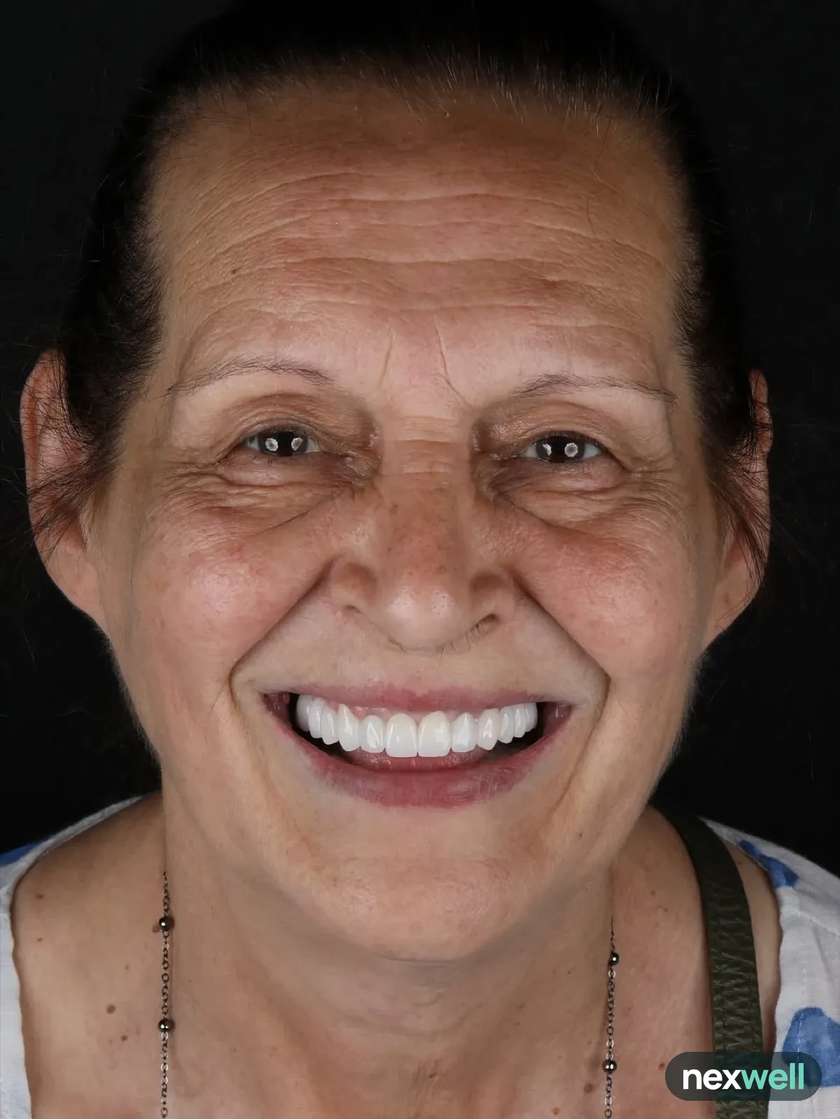 Full mouth implant restoration: after