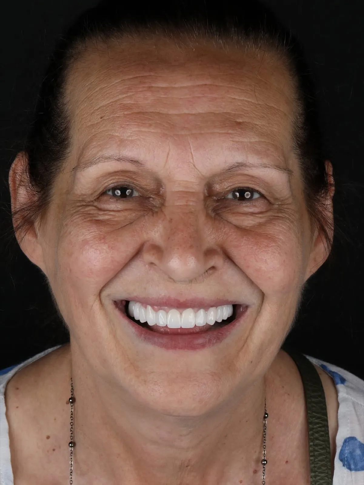 Full face portrait of a smiling senior woman showing a natural-looking full mouth dental implant result, Turkey dental clinic.