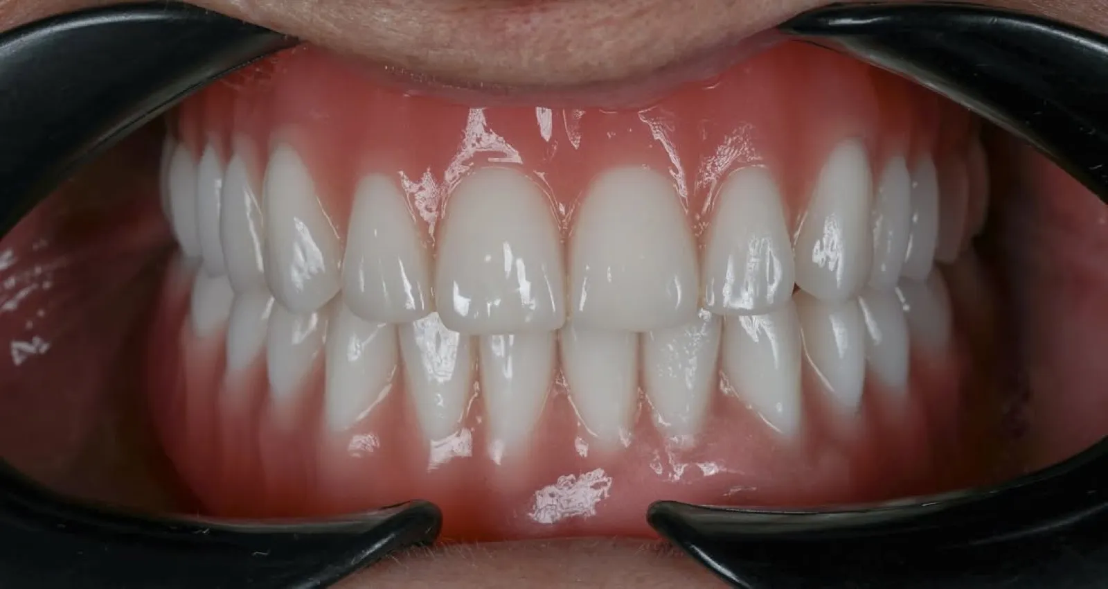 Close-up of upper and lower dental arches with cheek retractors showing a full mouth implant zirconia prosthesis result, Turkey dental clinic.