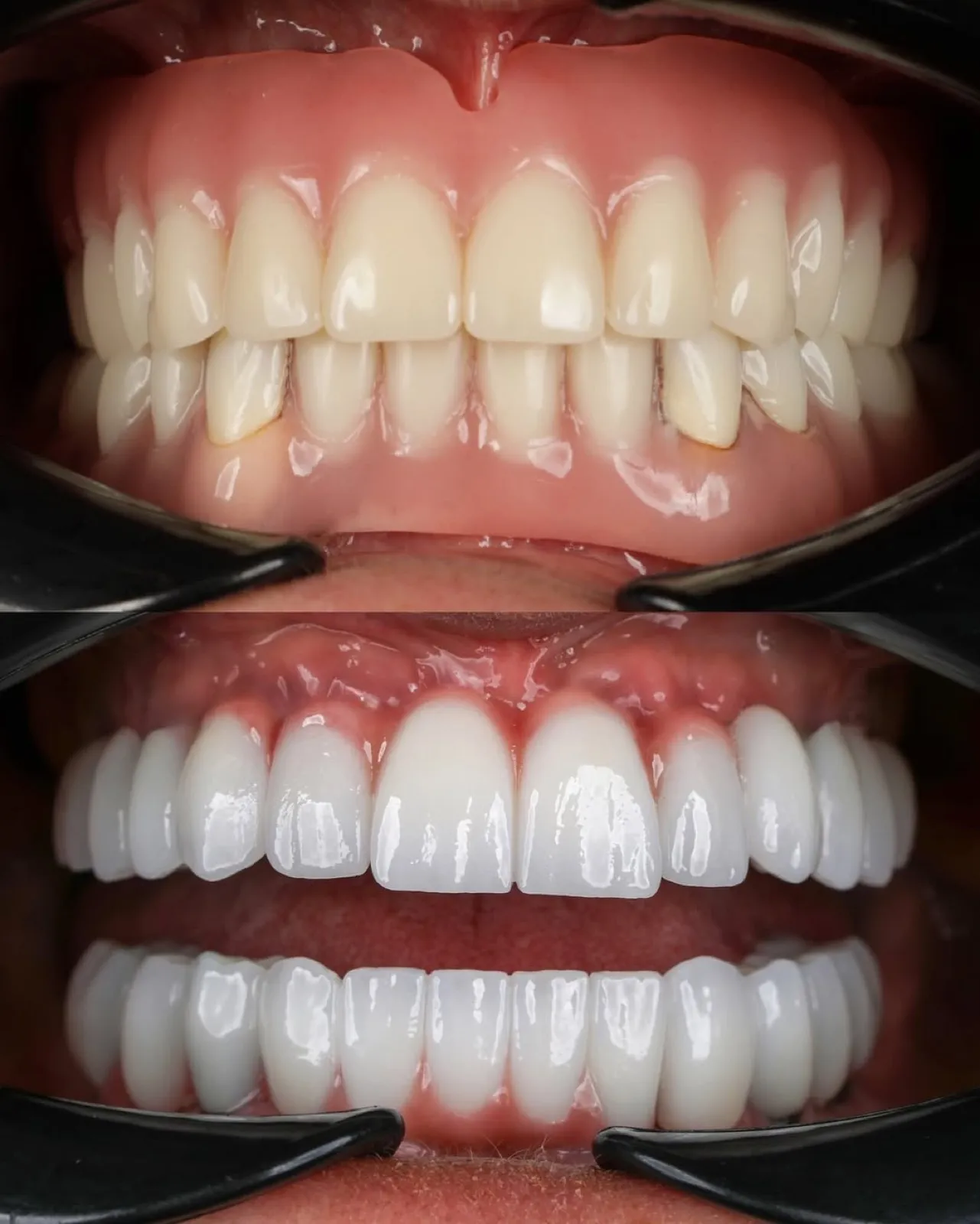 All-on-Six dental implant before and after comparison, damaged and discolored teeth replaced with a fixed, natural-looking white full-arch prosthesis, Turkey dental clinic.