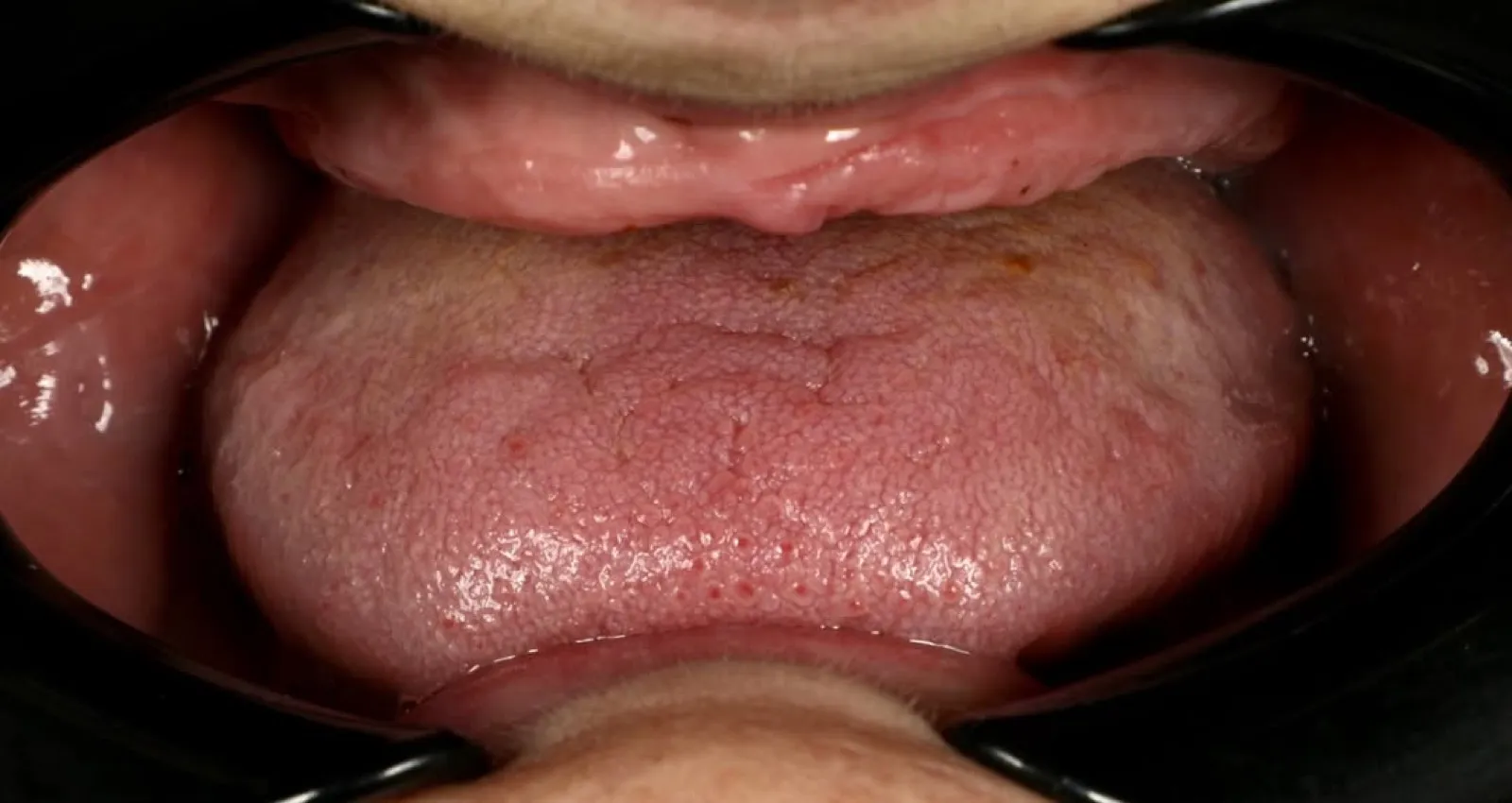 Close-up intraoral clinical photo of the tongue and lower oral cavity taken during a full mouth dental implant case documentation, Turkey dental clinic.