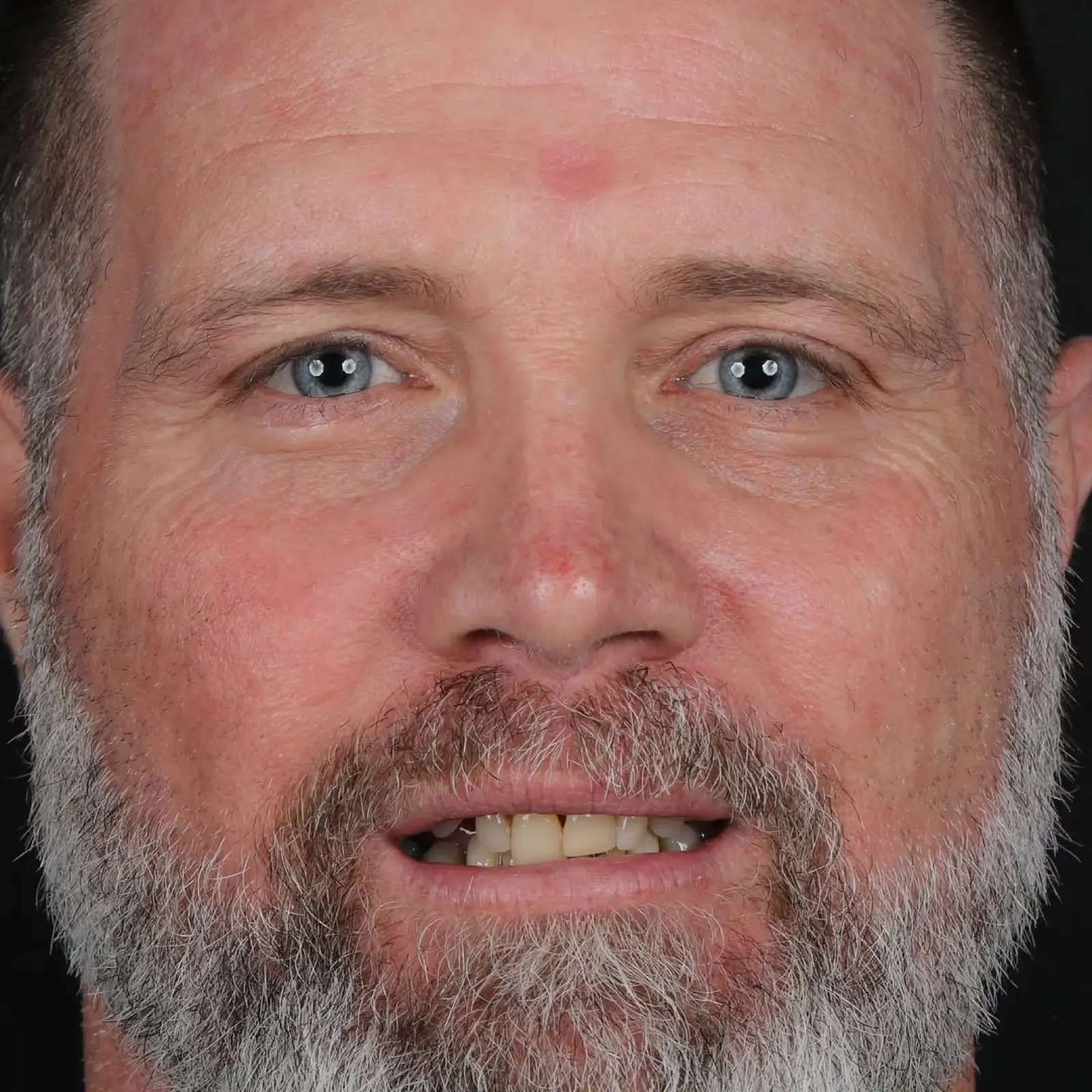 Full mouth dental implant patient before photo, full face, showing worn and discolored front teeth prior to All-on-Six restoration, Turkey dental clinic.