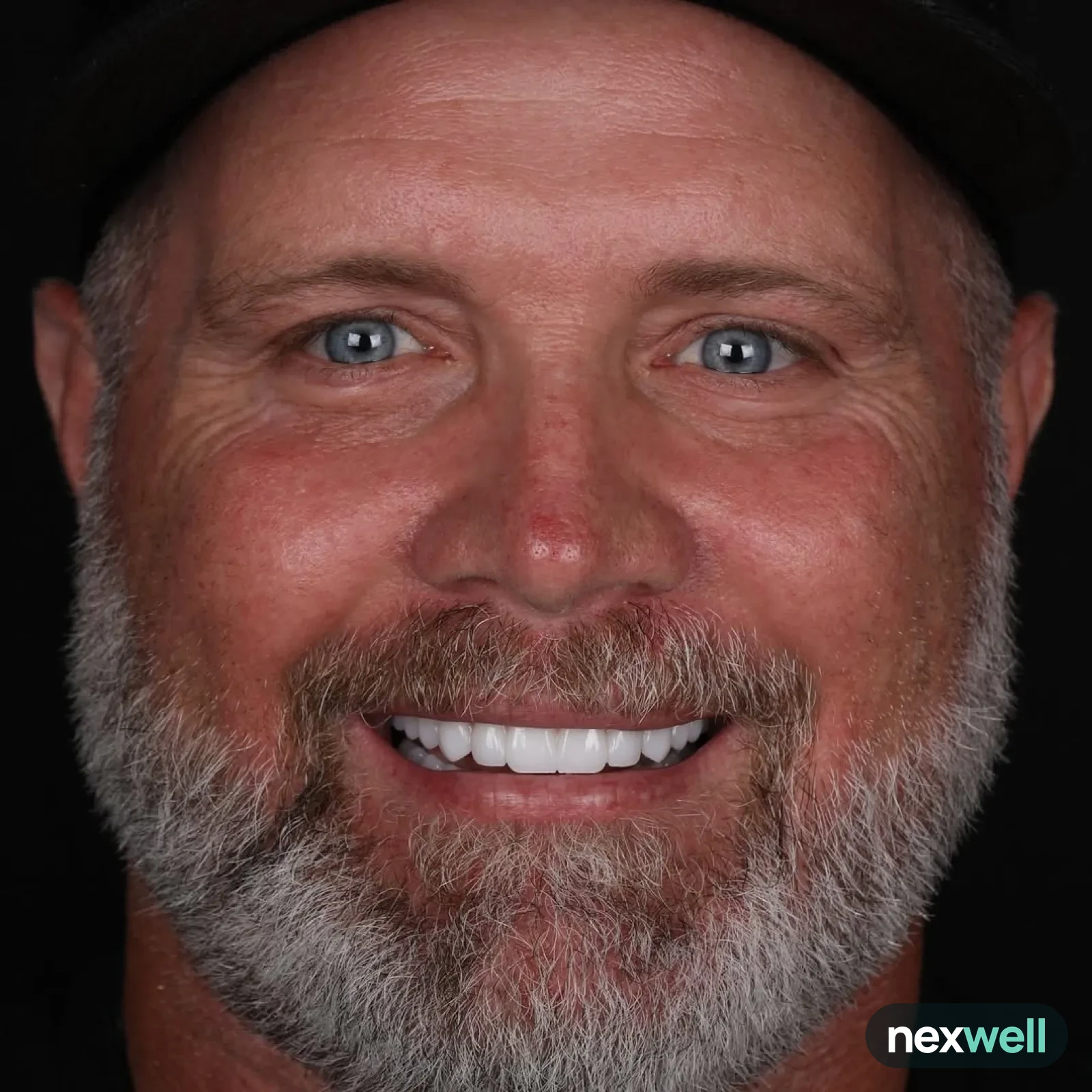 Full-arch implant restoration: after