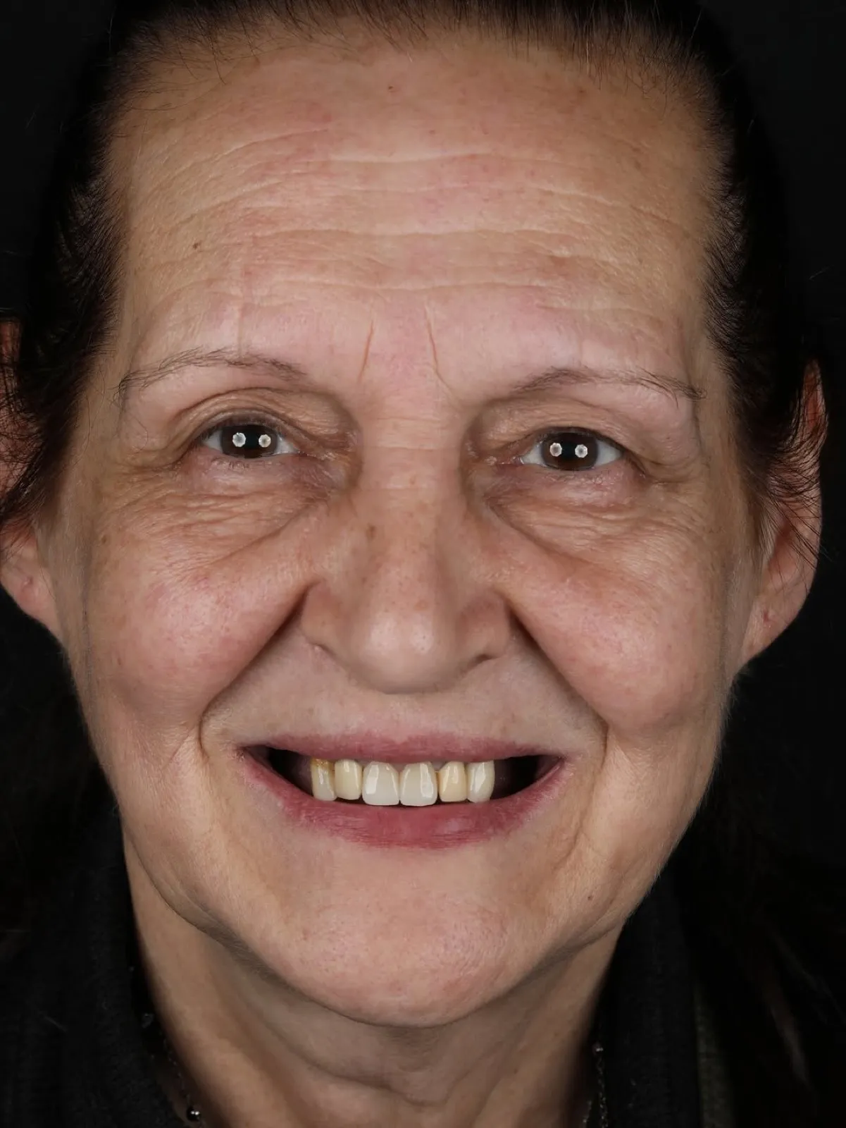 Dental implant patient before photo, full face, elderly woman showing missing and discolored front teeth prior to full mouth restoration, Turkey dental clinic.