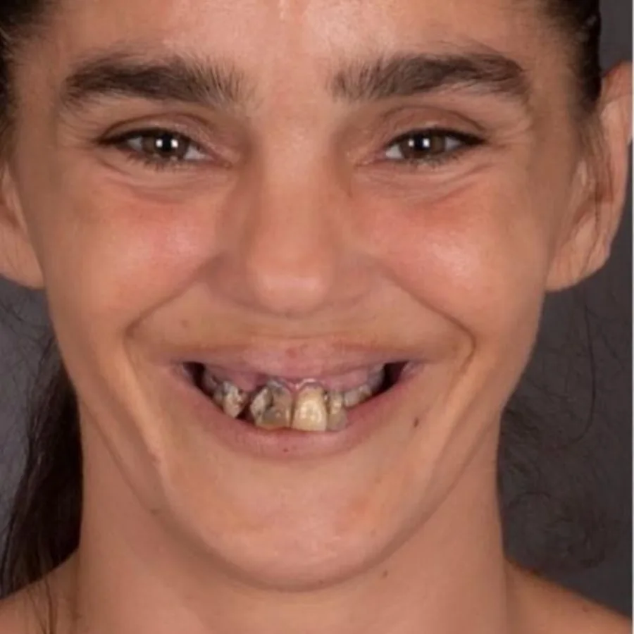 Before: full mouth All-on-6 implant restoration, 2001
