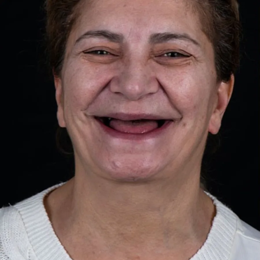 Before: full mouth All-on-6 implant restoration, 2002