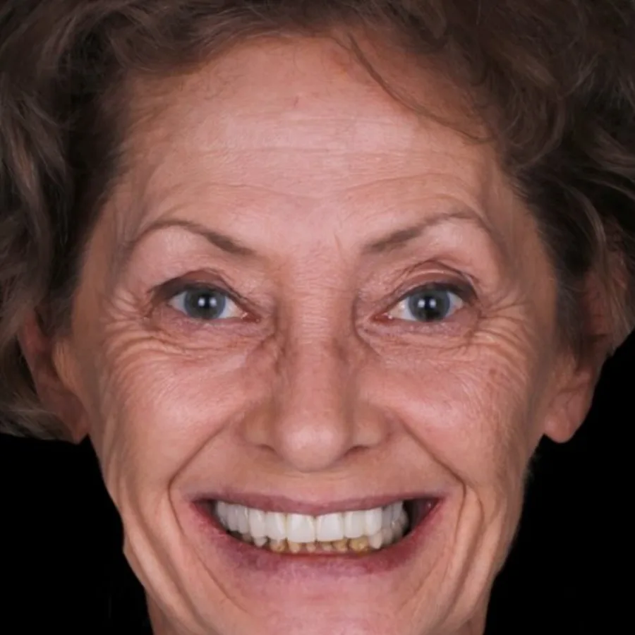 Before: full mouth All-on-6 implant restoration, 2003