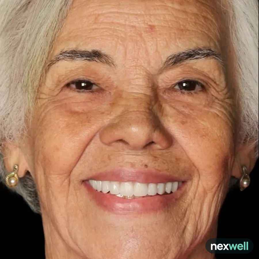 After: full mouth All-on-6 implant restoration, 2004
