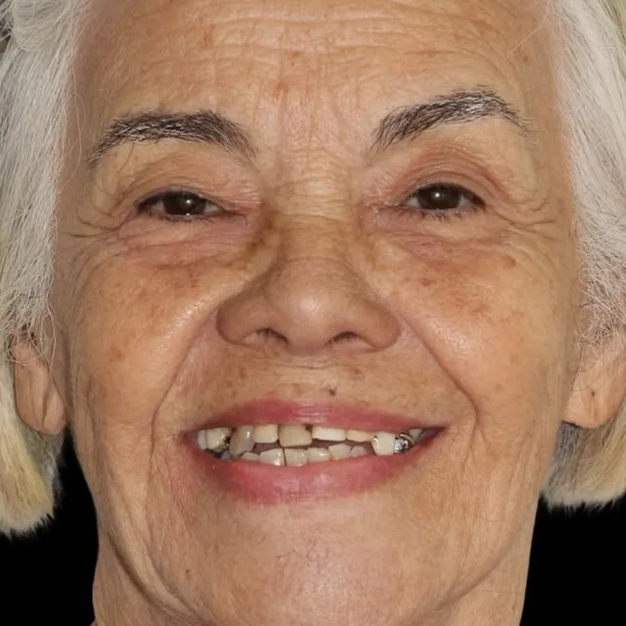 Before: full mouth All-on-6 implant restoration, 2004