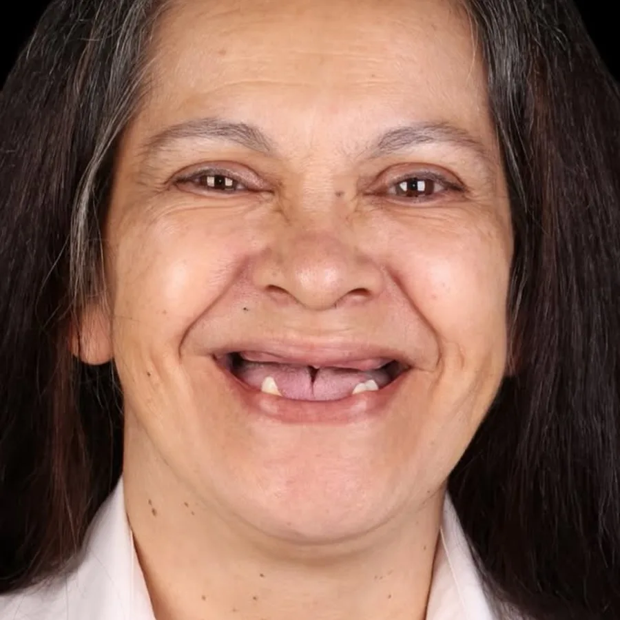 Before: full mouth All-on-6 implant restoration, 2005