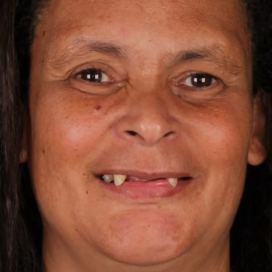 Before: full mouth All-on-6 implant restoration, 2006