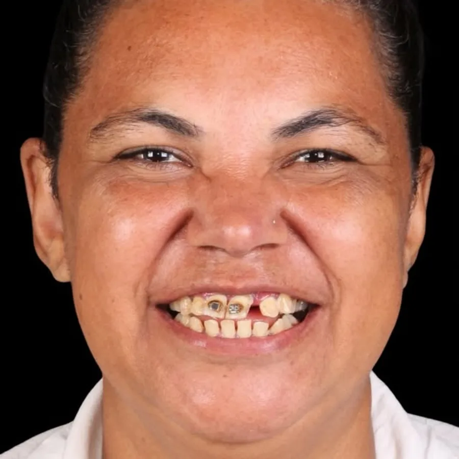 Before: full mouth All-on-6 implant restoration, 2007
