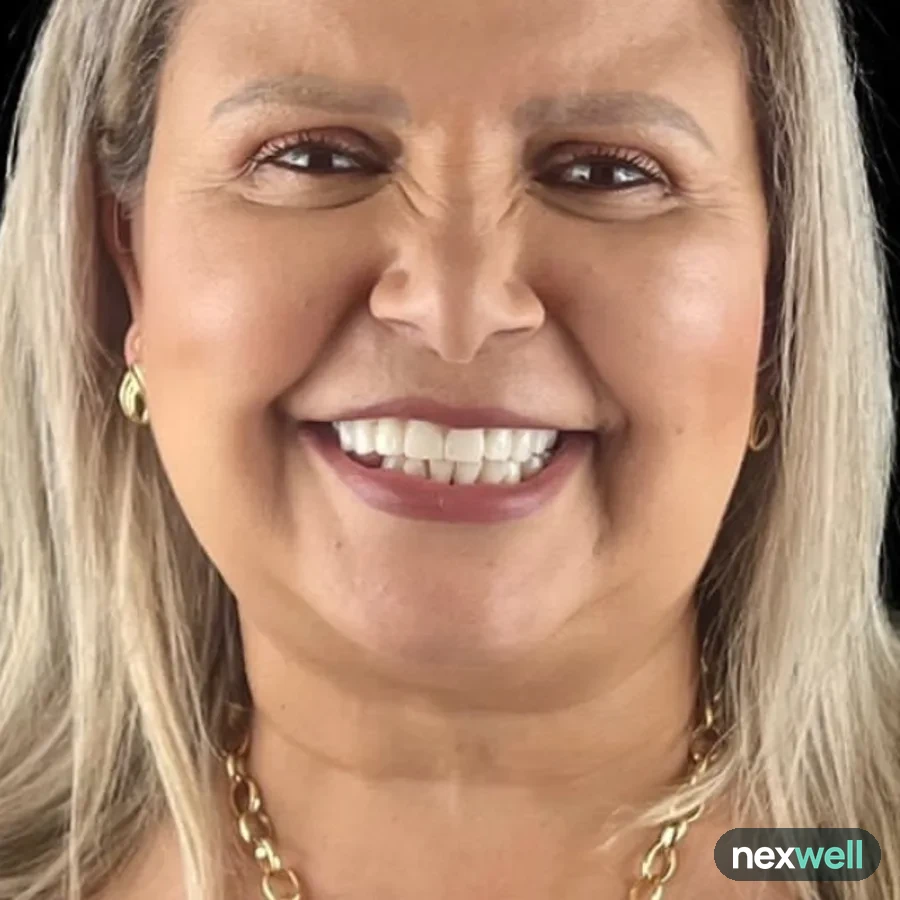 After: full mouth All-on-6 implant restoration, 2010