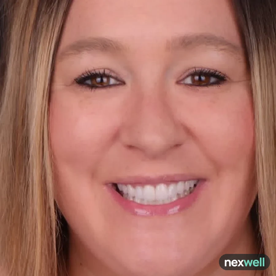 After: full mouth All-on-6 implant restoration, 2011