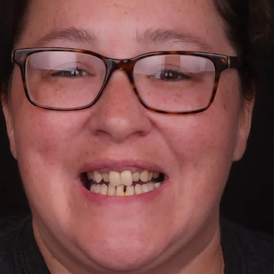 Before: full mouth All-on-6 implant restoration, 2011