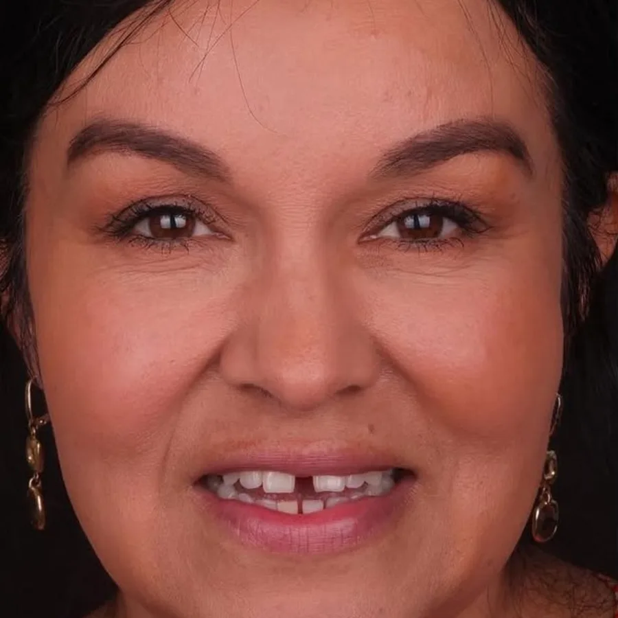 Before: full mouth All-on-6 implant restoration, 2012