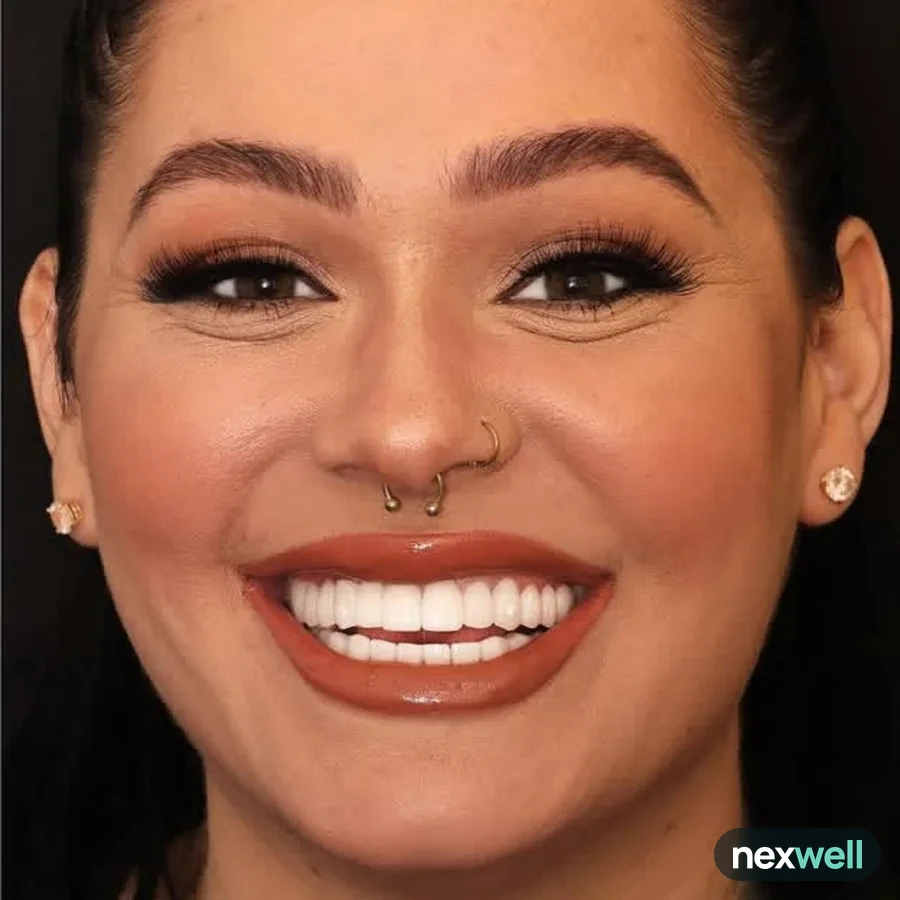 After: full mouth All-on-6 implant restoration, 2014