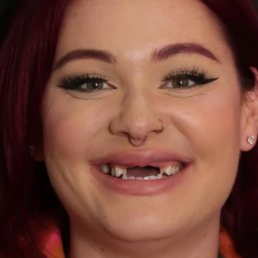 Before: full mouth All-on-6 implant restoration, 2014