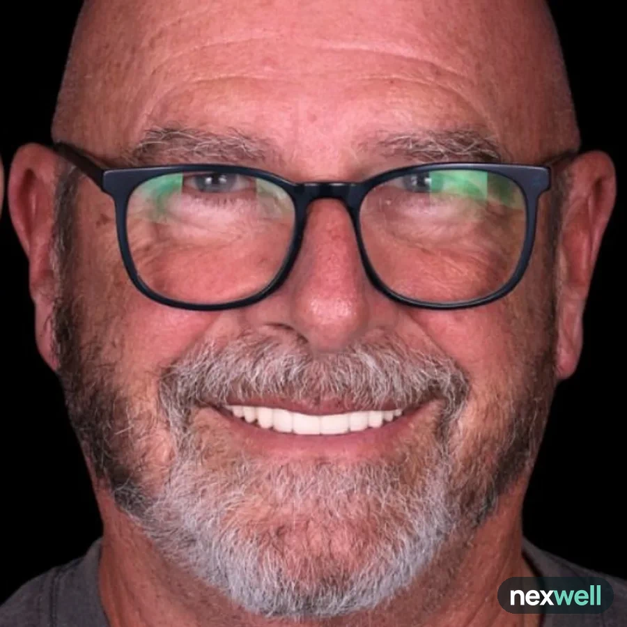After: full mouth All-on-6 implant restoration, 2015