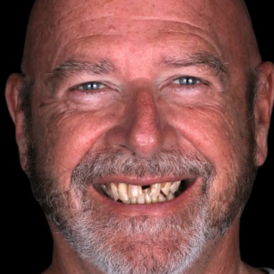 Before: full mouth All-on-6 implant restoration, 2015
