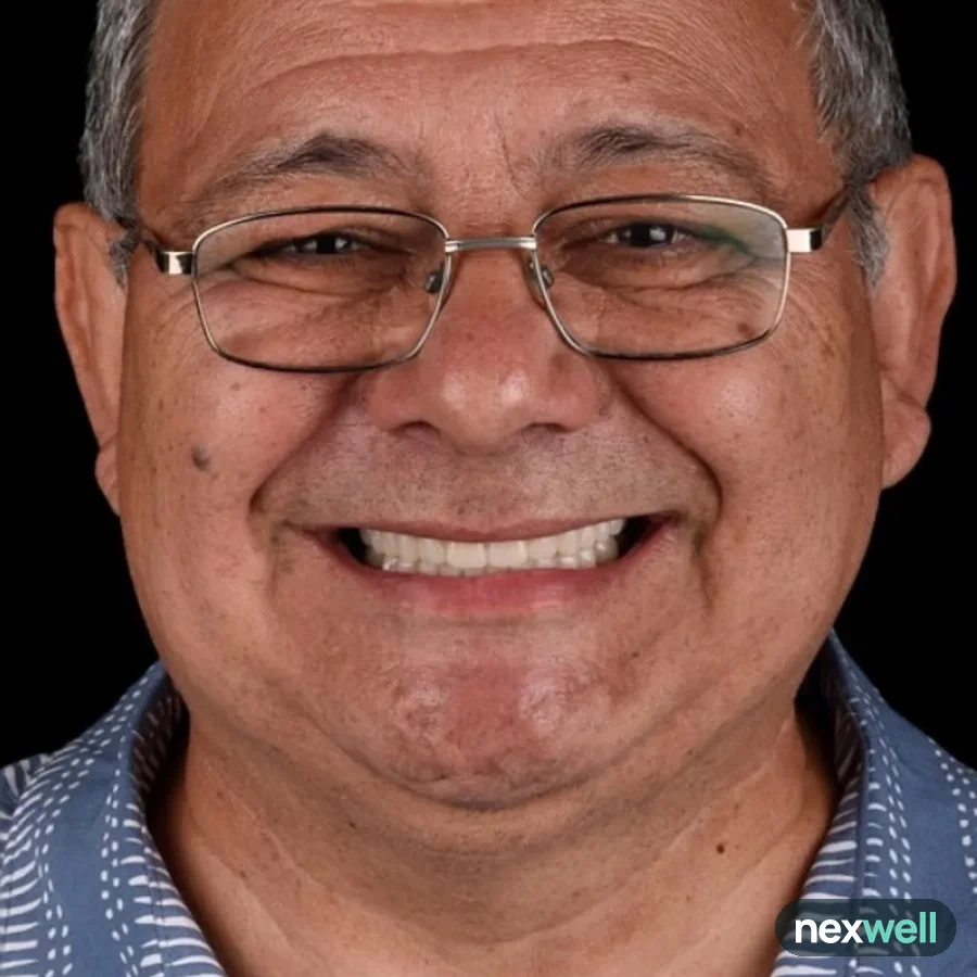 After: full mouth All-on-6 implant restoration, 2016