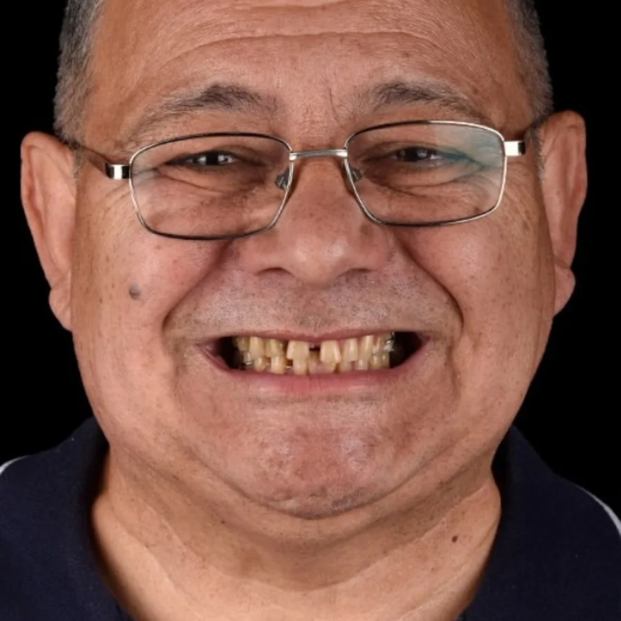 Before: full mouth All-on-6 implant restoration, 2016