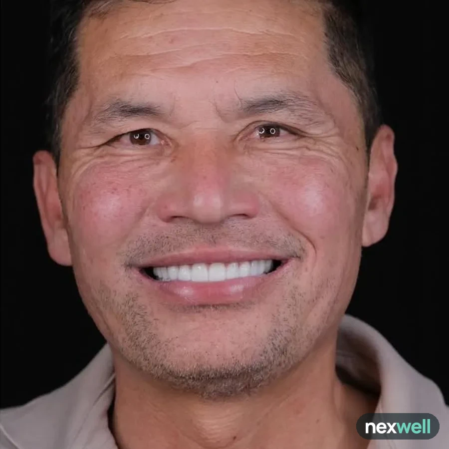 After: full mouth All-on-6 implant restoration, 2017