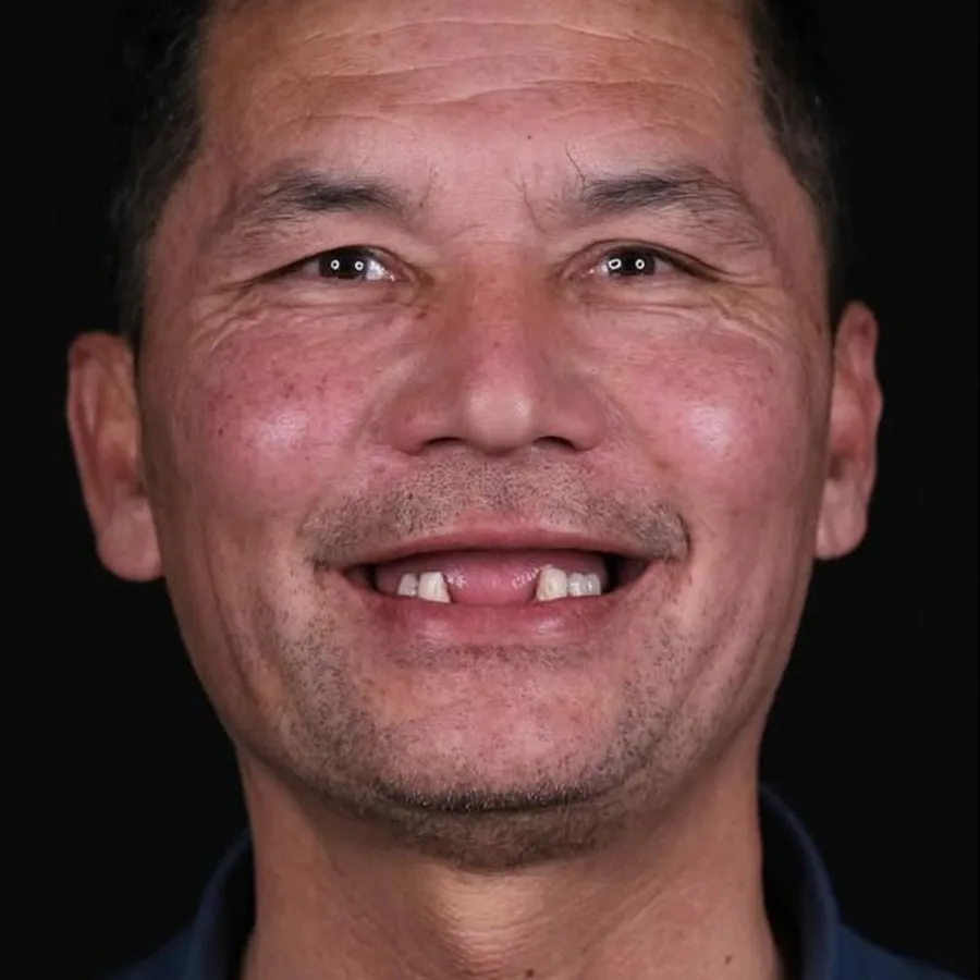 Before: full mouth All-on-6 implant restoration, 2017