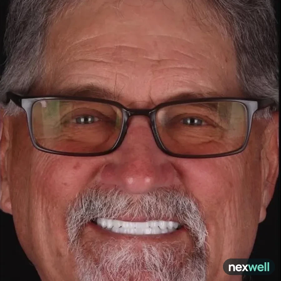 After: full mouth All-on-6 implant restoration, 2018