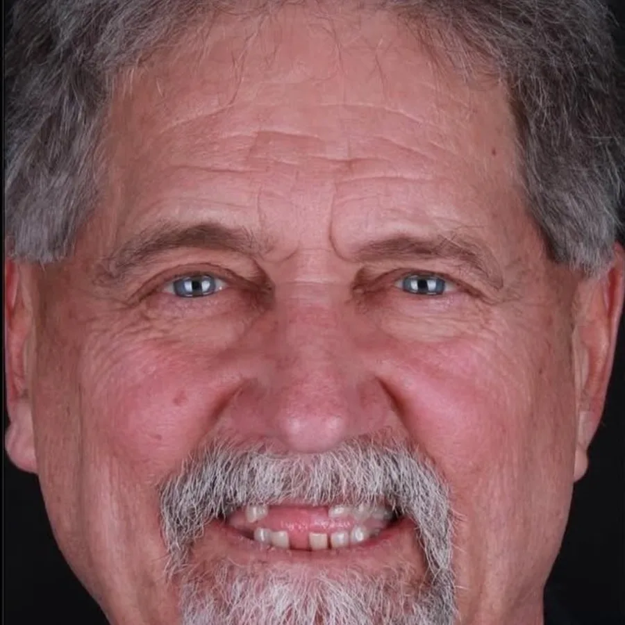 Before: full mouth All-on-6 implant restoration, 2018