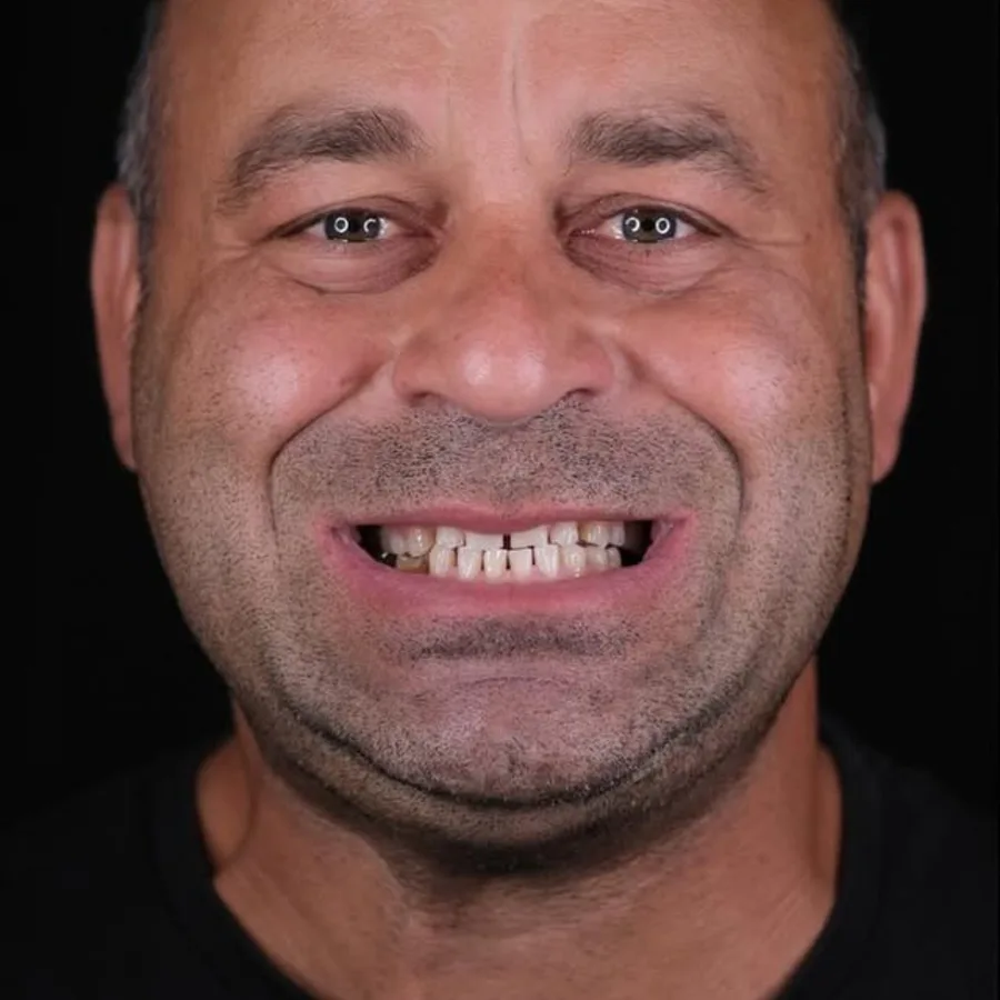 Before: full mouth All-on-6 implant restoration, 2019