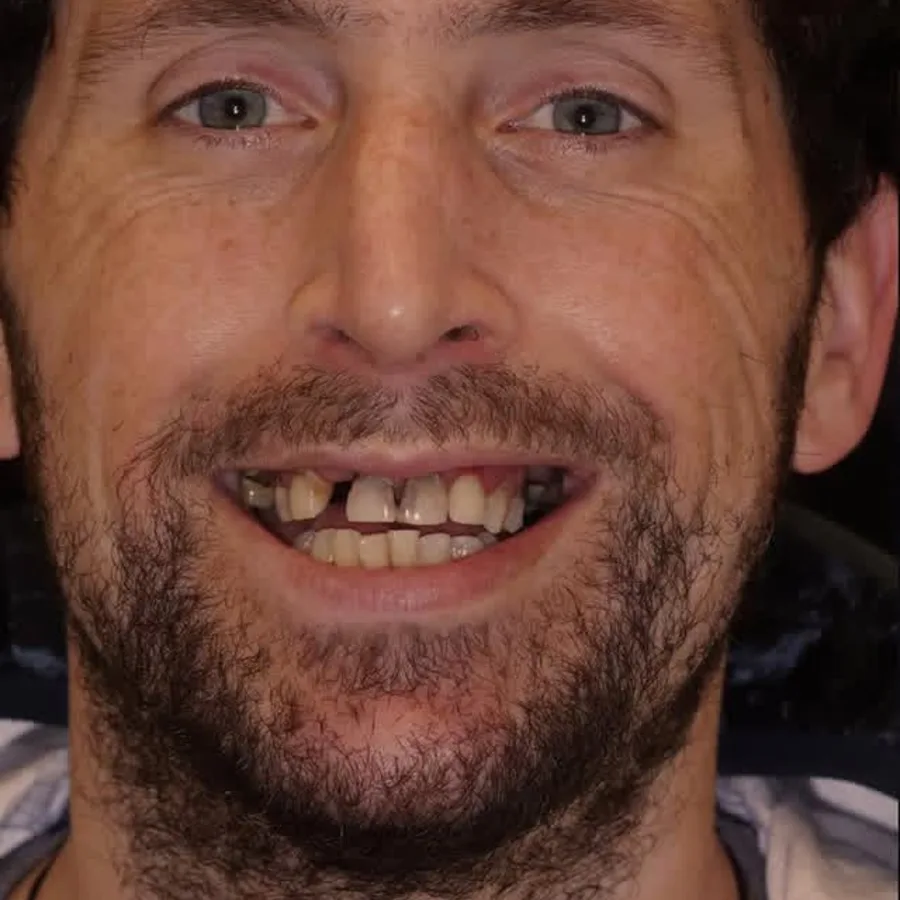 Before: full mouth All-on-6 implant restoration, 2020