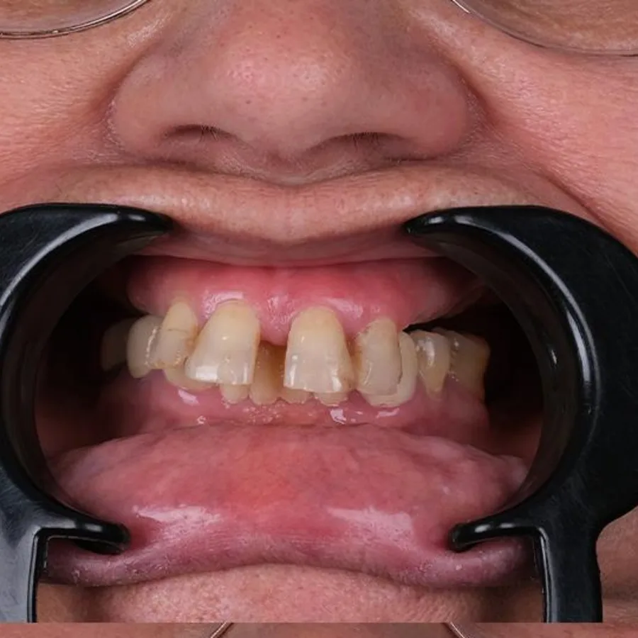 Before: full mouth All-on-6 implant restoration, 2021